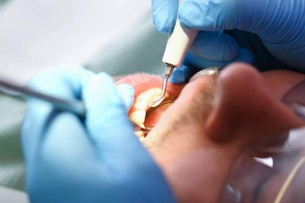 Best Emergency Root Canal Treatment in Carthage, IL