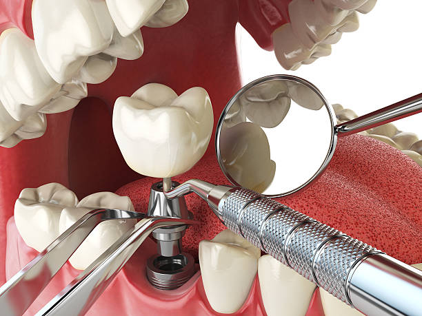 Best Emergency Tooth Extraction in Carthage, IL